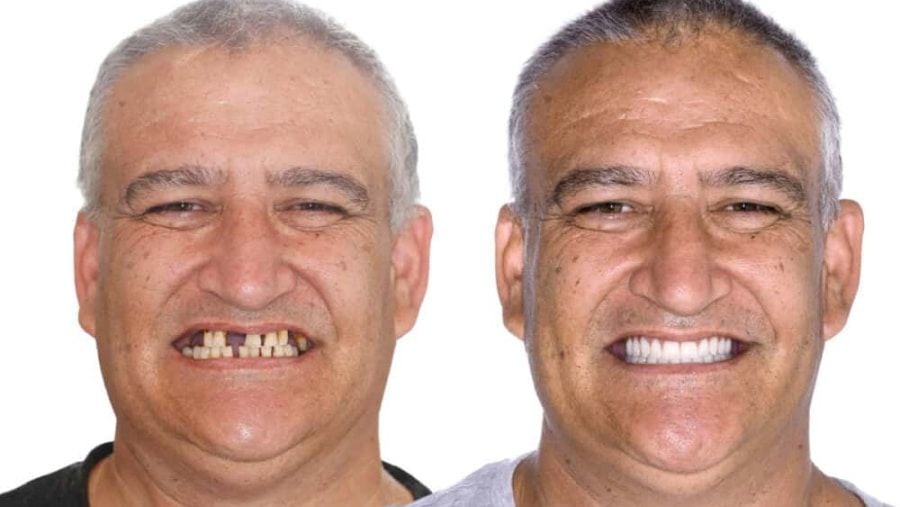 Elder People Can Now Have Their Teeth Substituted For Free