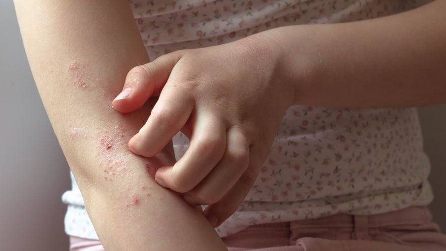 Everyone Should Know the Symptoms of Atopic Dermatitis