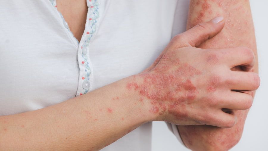 Understanding Plaque Psoriasis: Symptoms, Causes, and Treatment