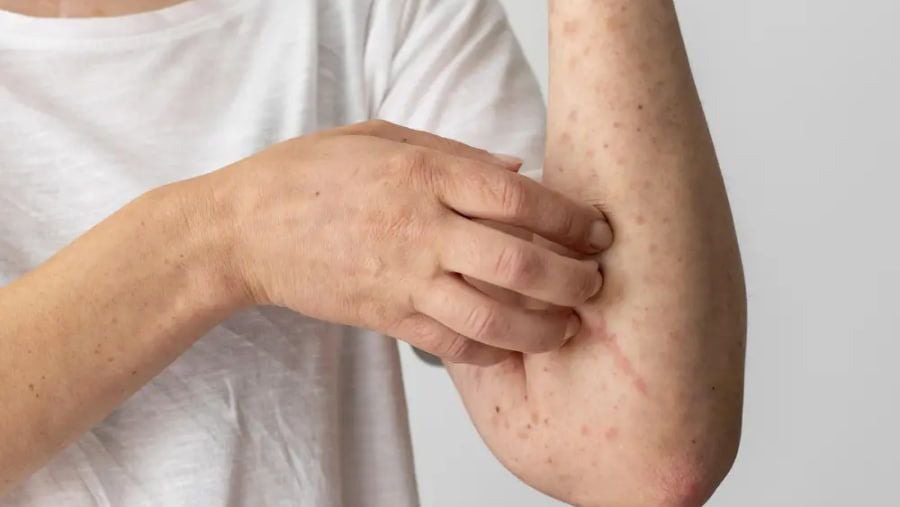 Jeder sollte die Symptome der atopischen Dermatitis kennen